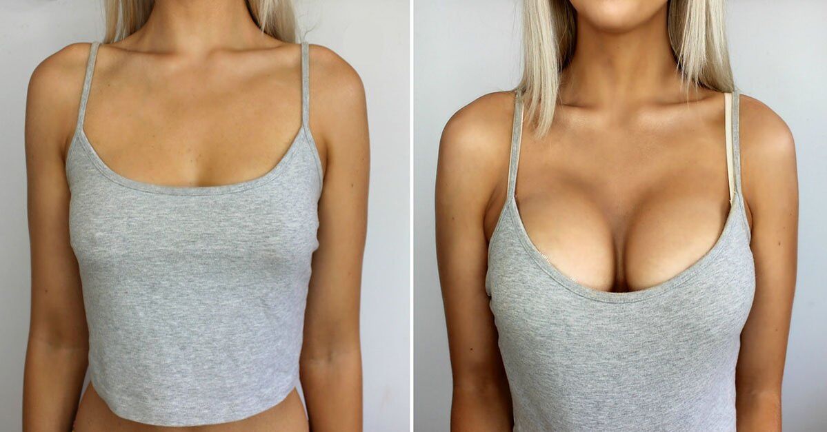 Before and after breast augmentation