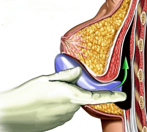 implantation for breast enlargement