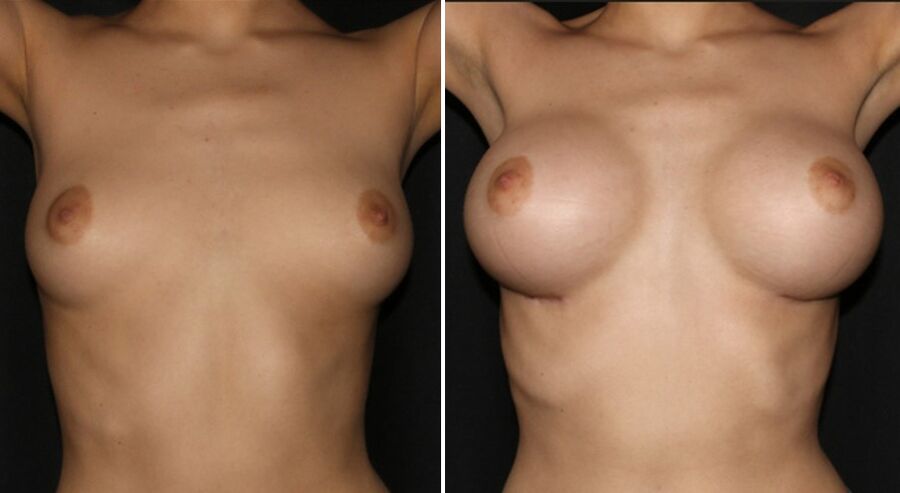 Before and after breast augmentation surgery
